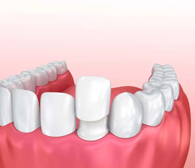 3D-Darstellung eines Unterkiefers mit einem Zahn, auf den ein Veneer gesetzt wird
